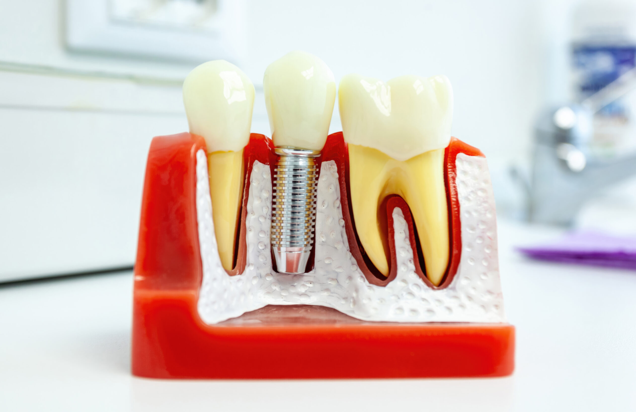 Discover dental implant solutions and explore affordable options like membership plans and The Patient Marketplace for a confident smile.