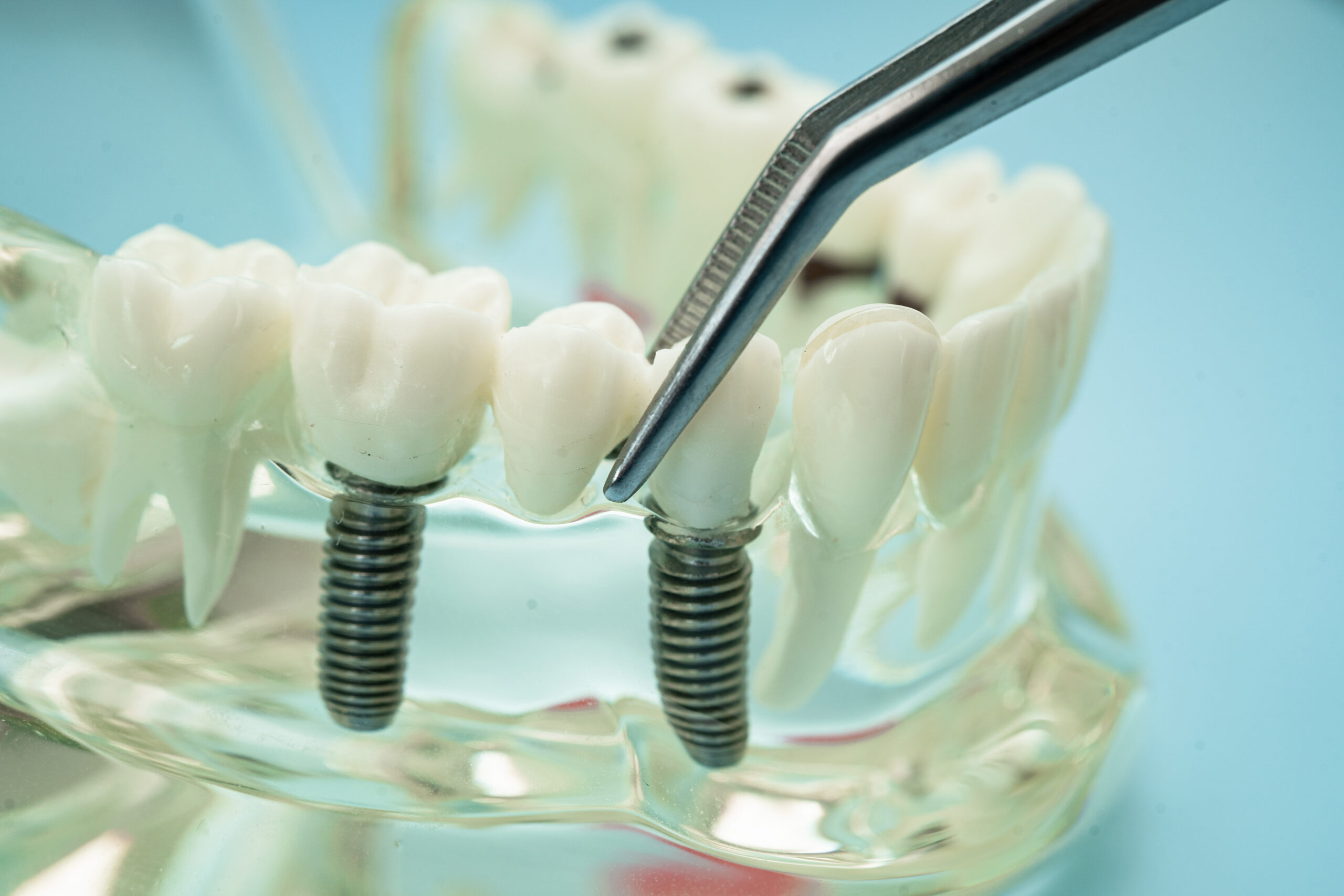 best dental implants
