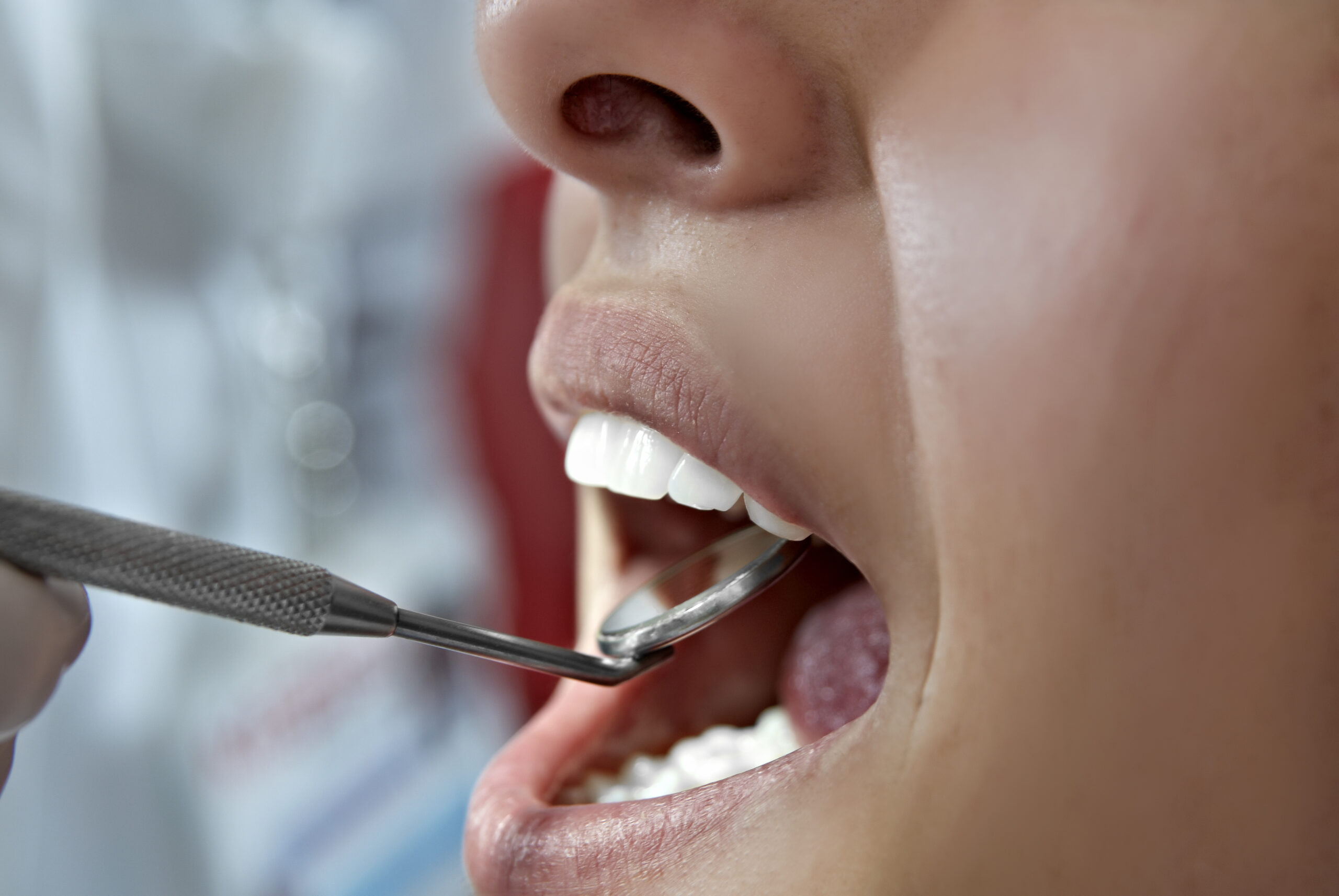 periodontal maintenance vs cleaning