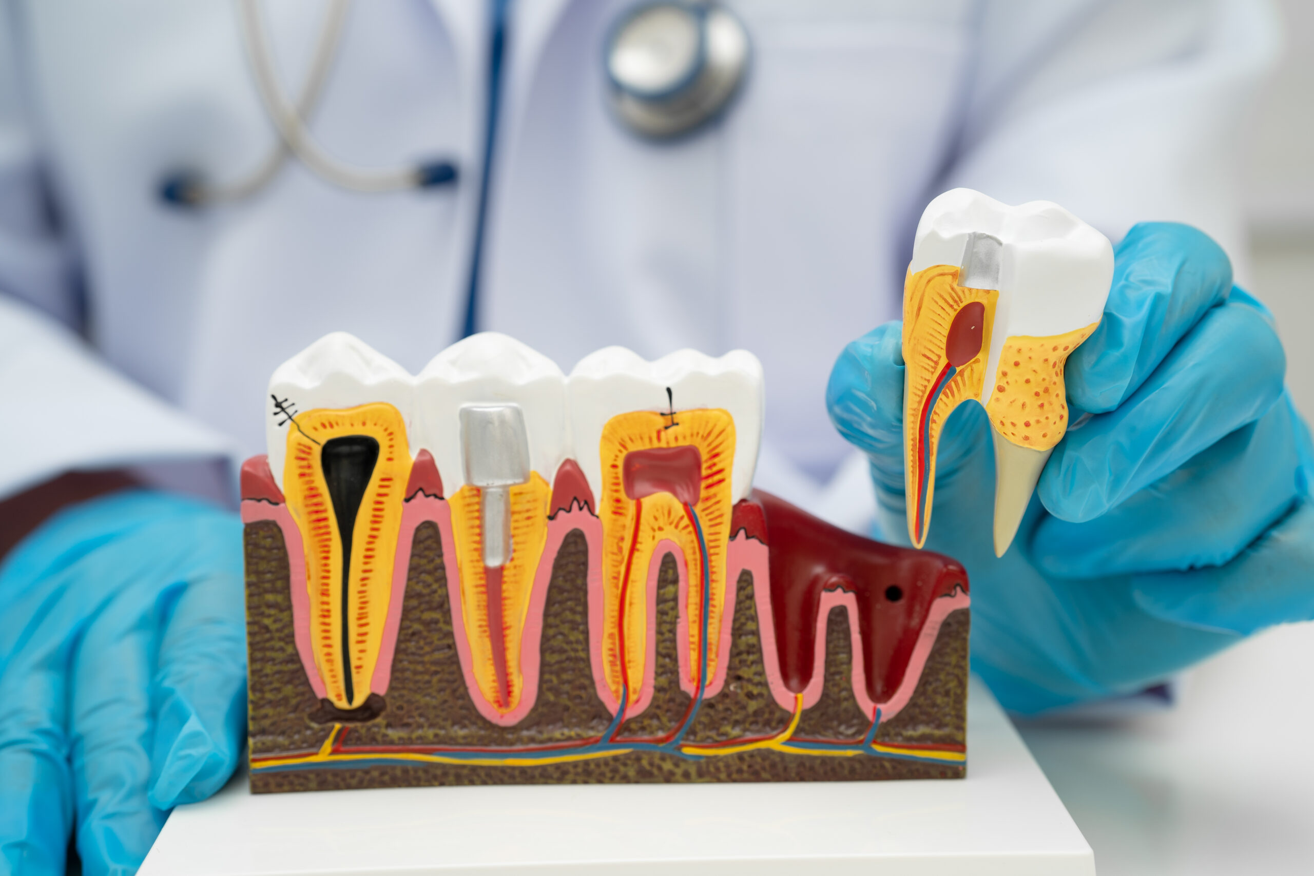 root canal and crown cost
