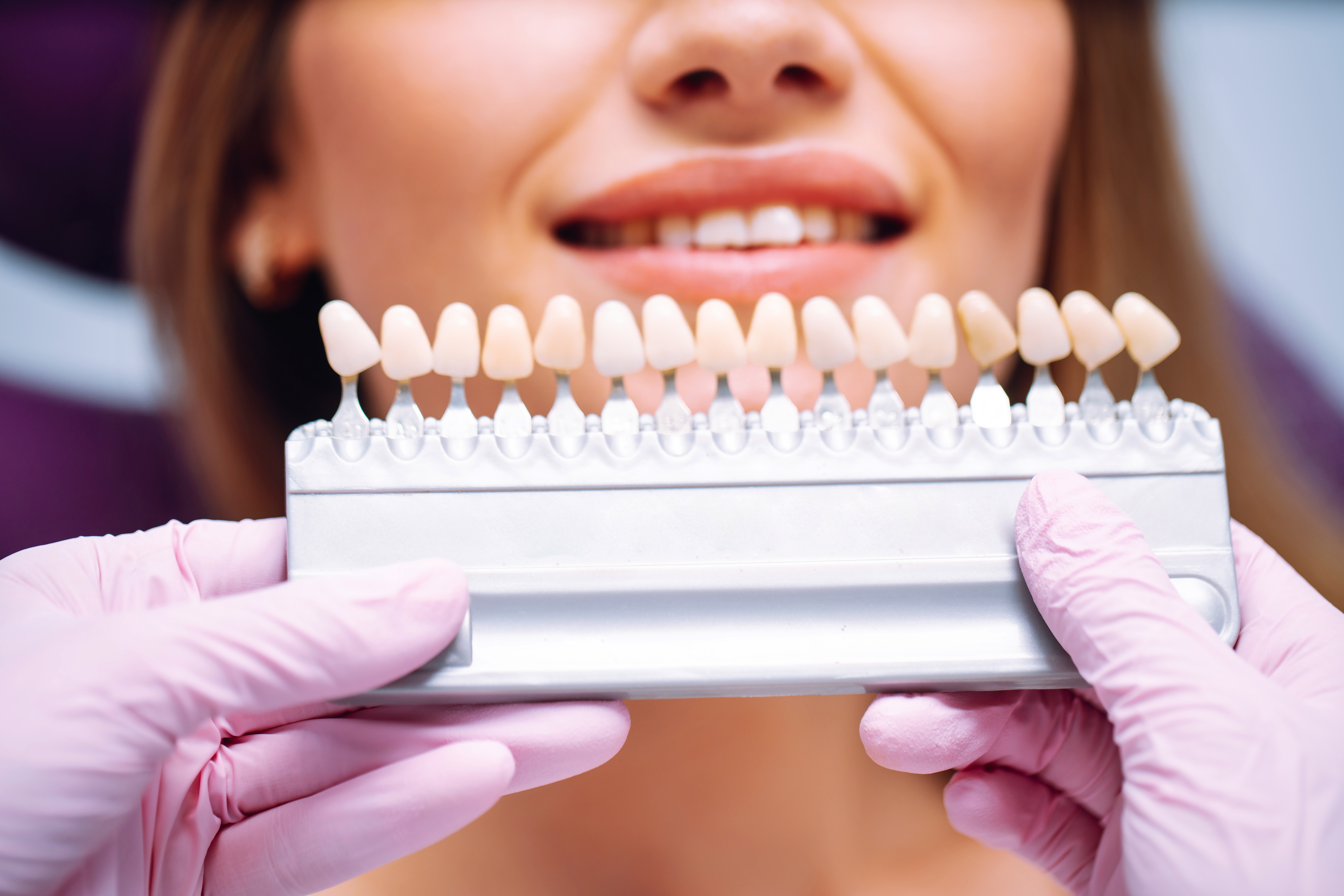cost of teeth whitening