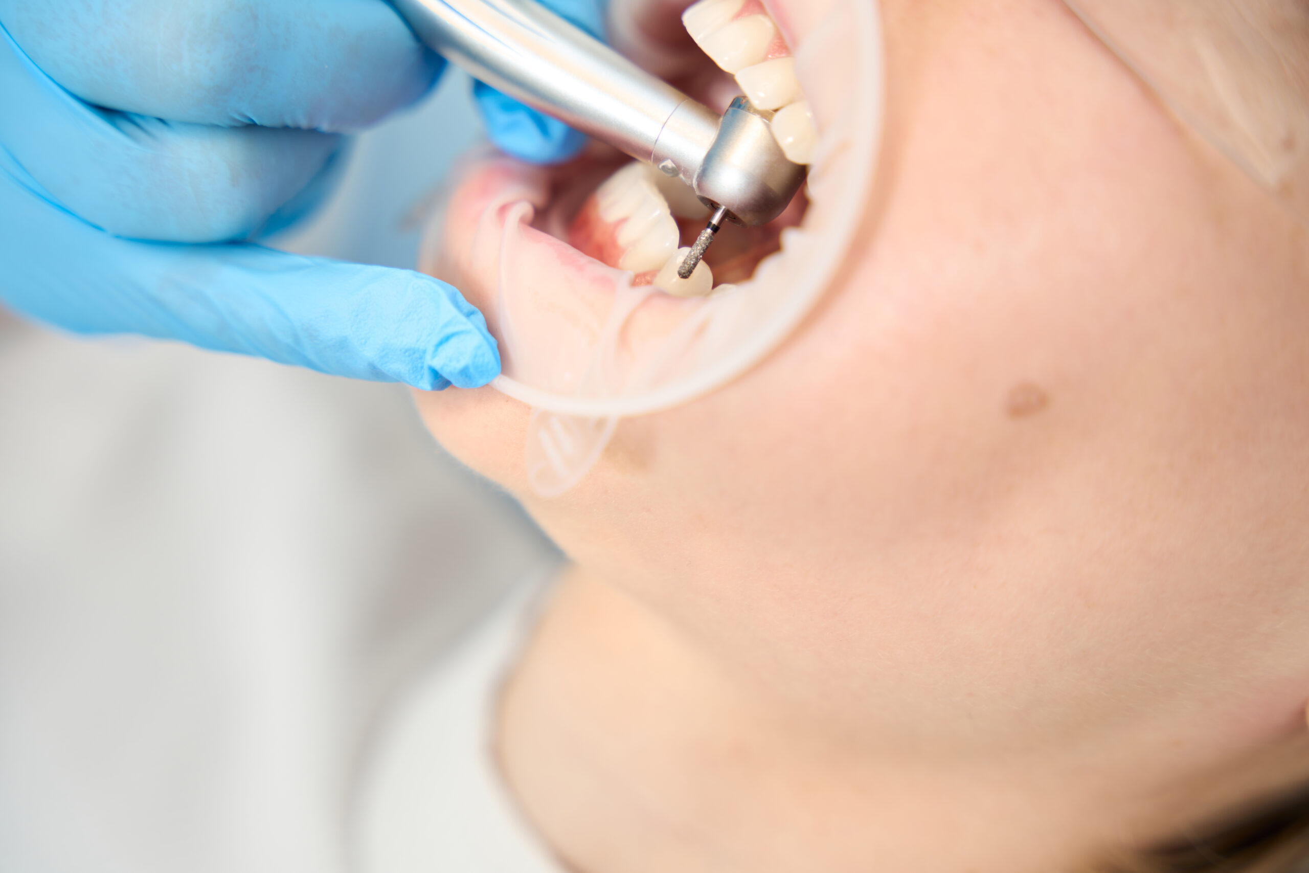 average cost of fillings