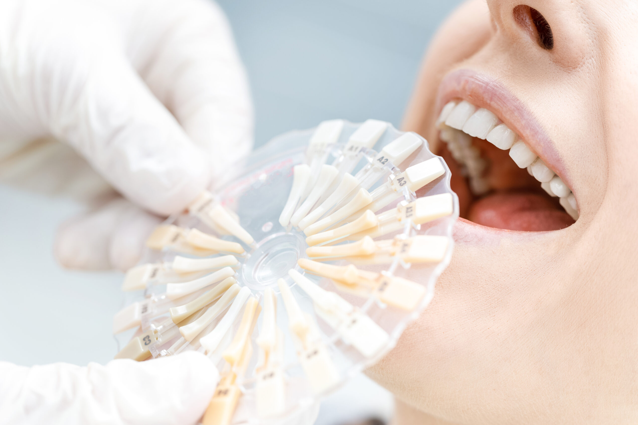 teeth lamination cost