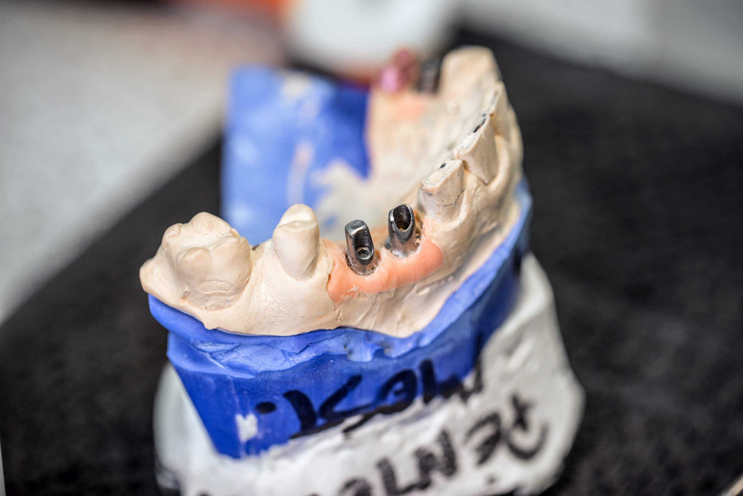 dental implant payment plan