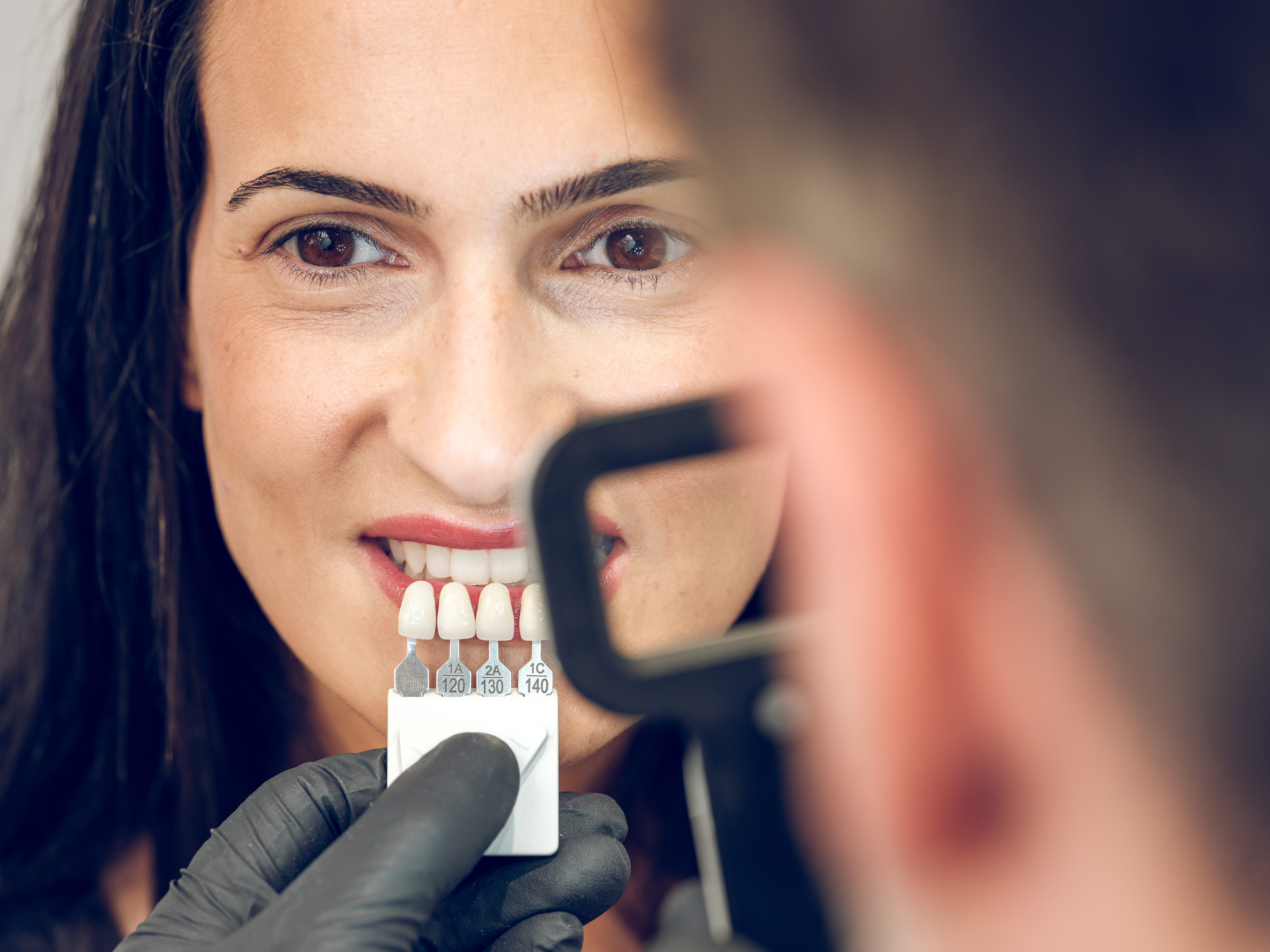 dental bonding cost