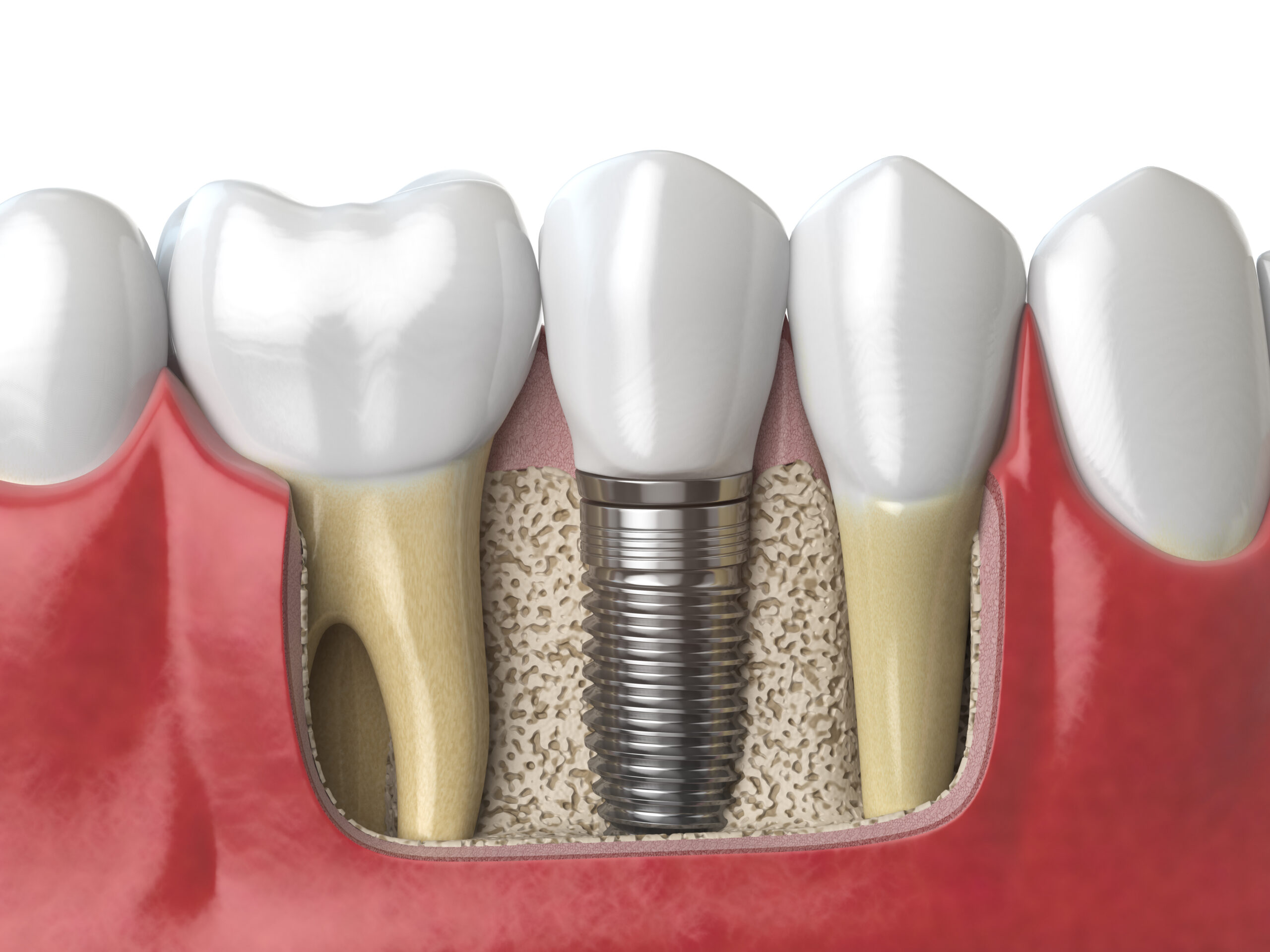 best dental implant prices
