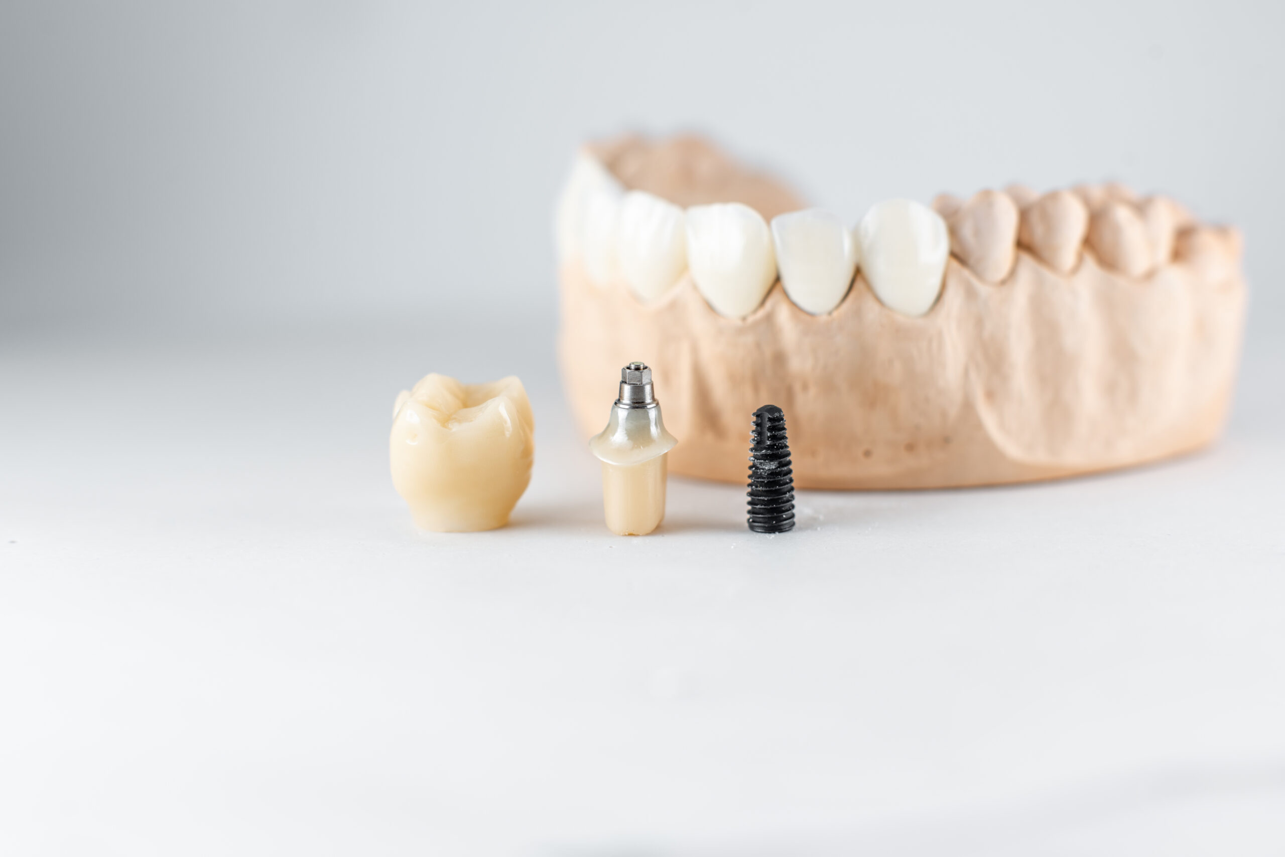 dental implant discount plan