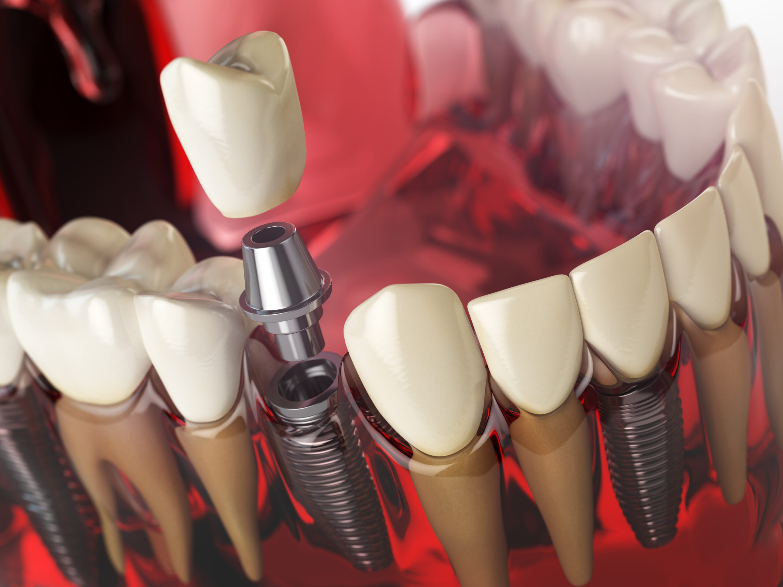 price of implants teeth