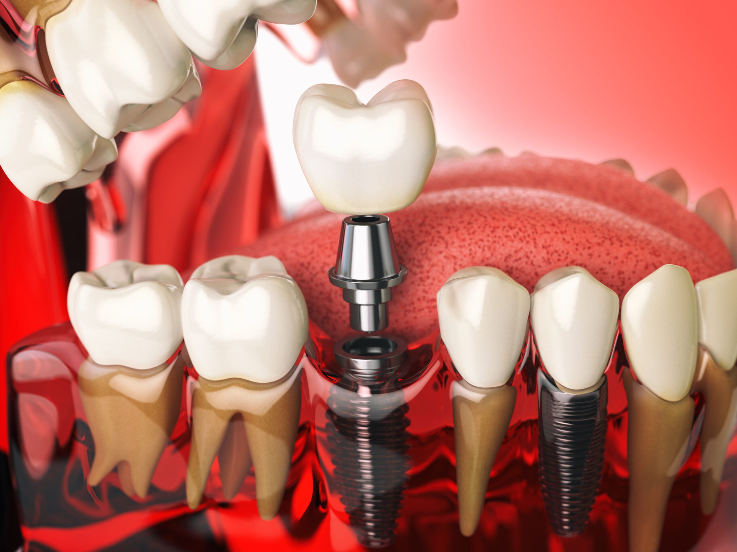 teeth implants before and after
