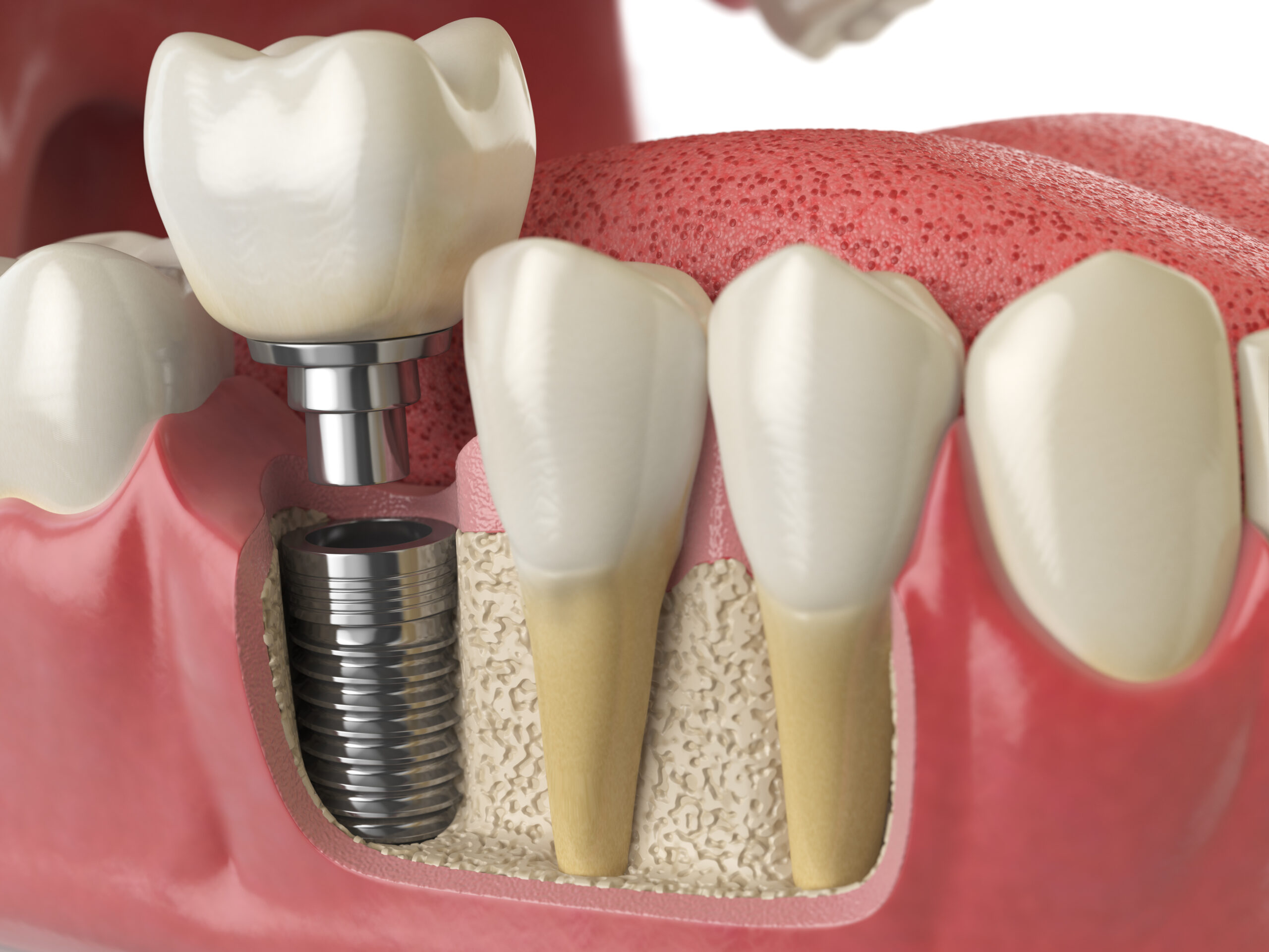 how much do dental implants cost?