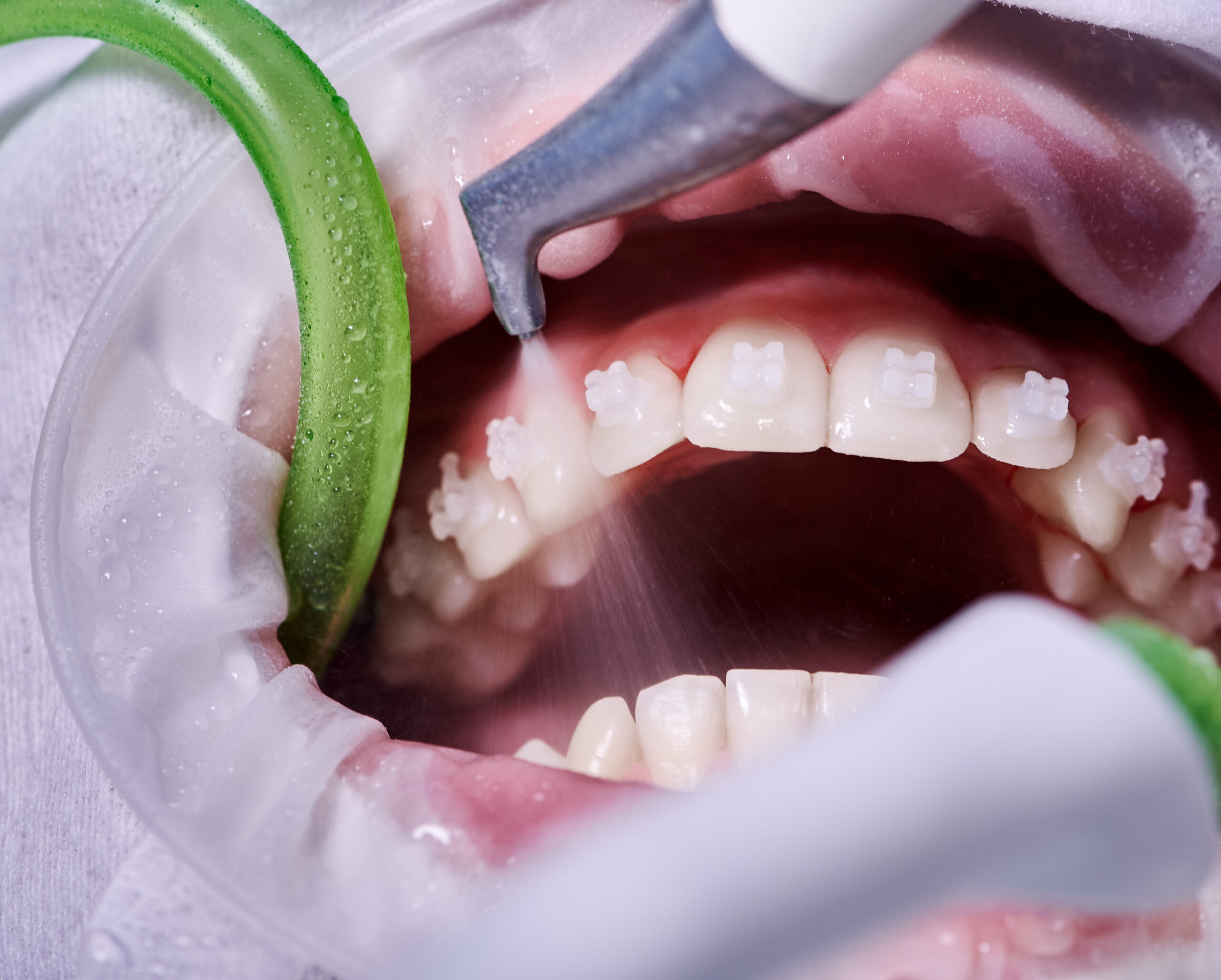 disadvantages of teeth cleaning