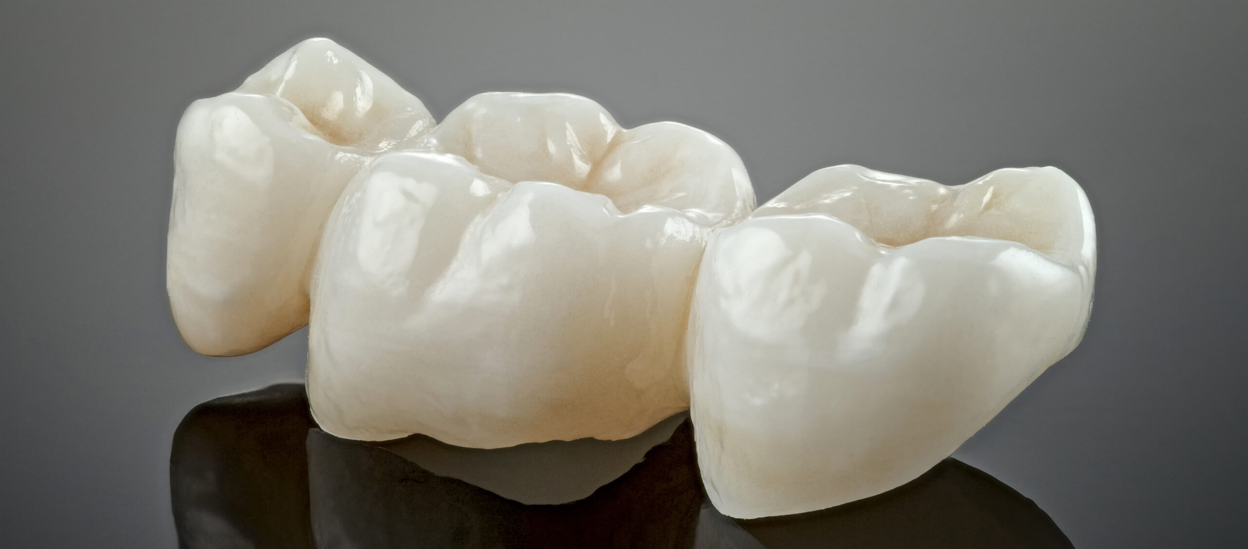 An example of zirconia crown price.
