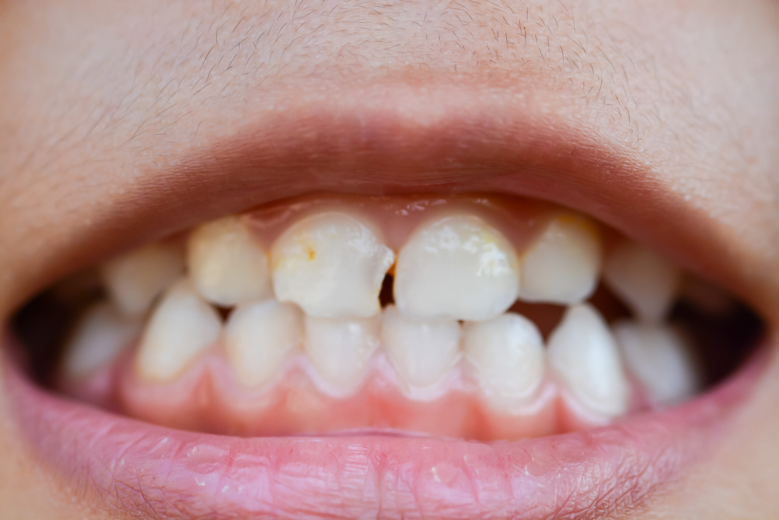 An example of brown spots on teeth.
