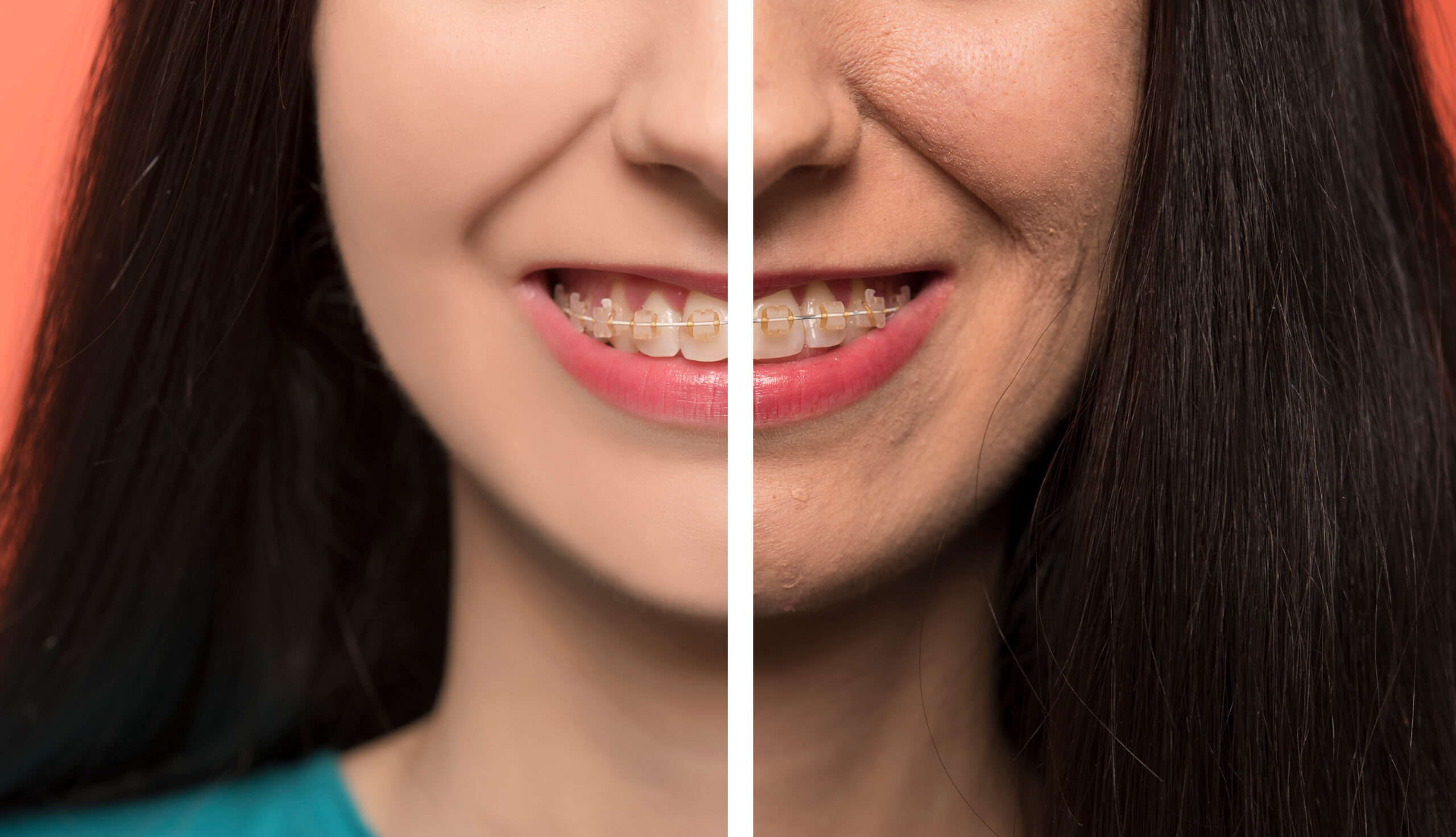 An example of before and after braces.