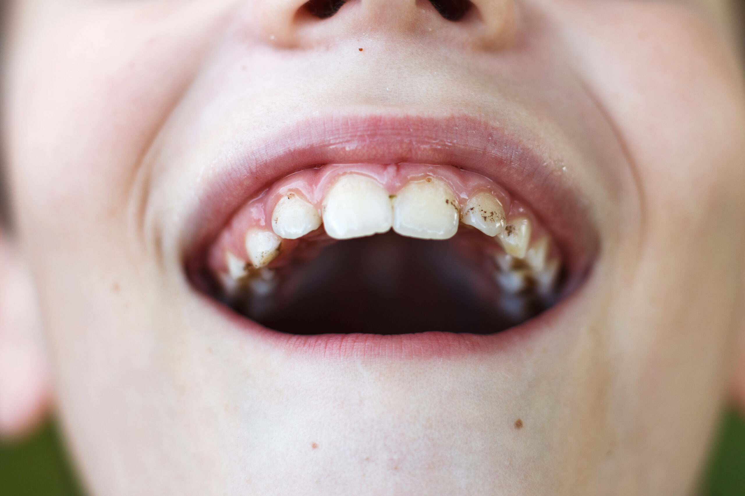 A child with teeth stains.