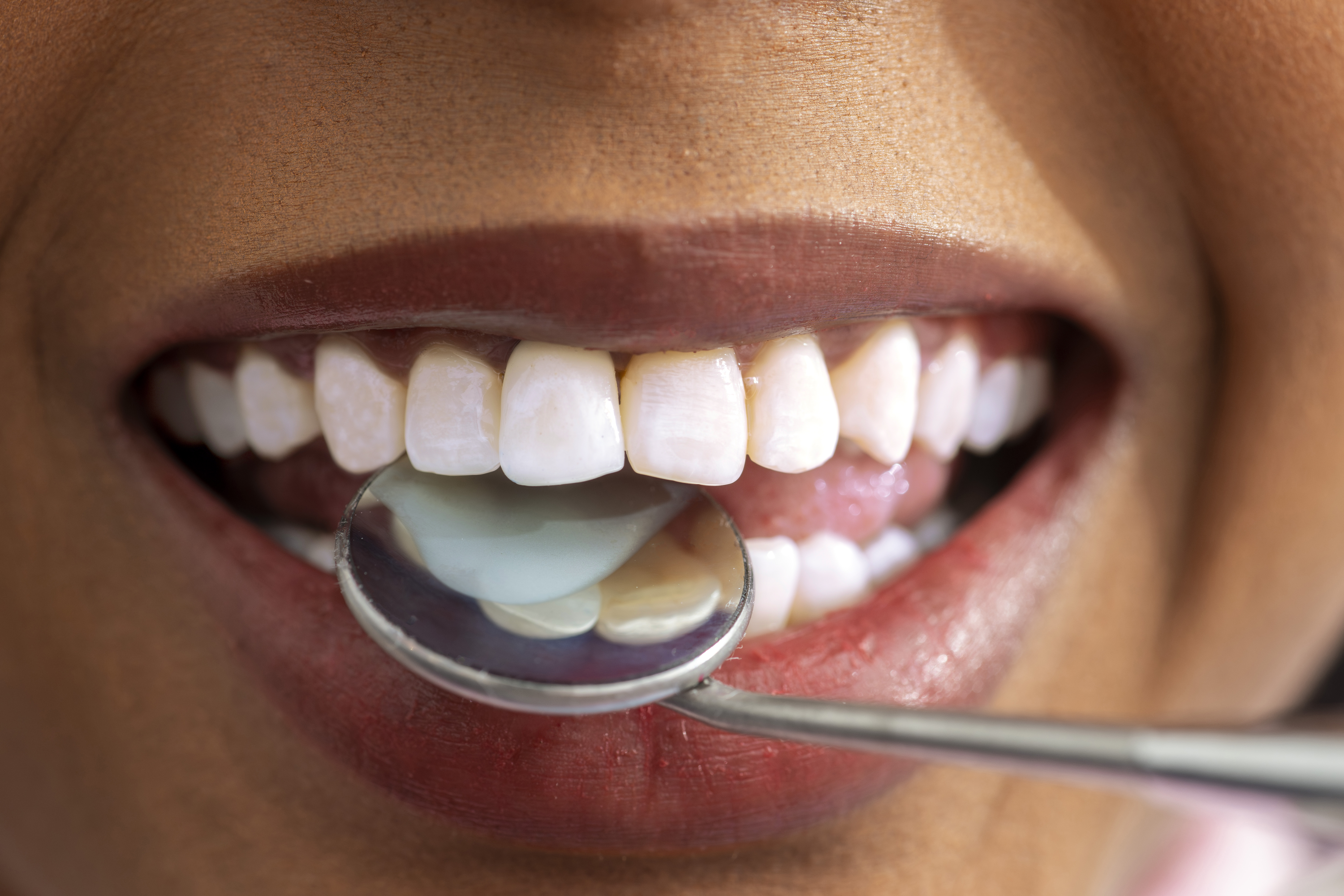 An example of fixing staining on teeth.