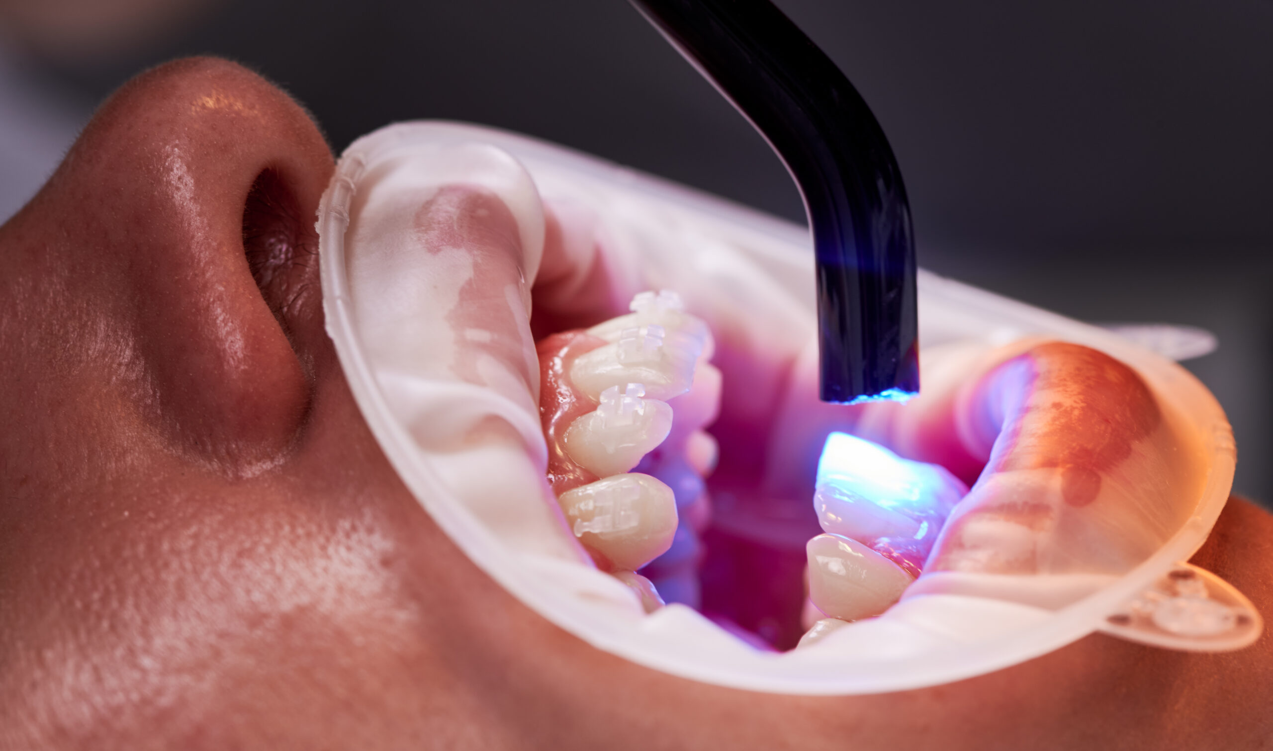 Laser teeth whitening costs in Tulsa.