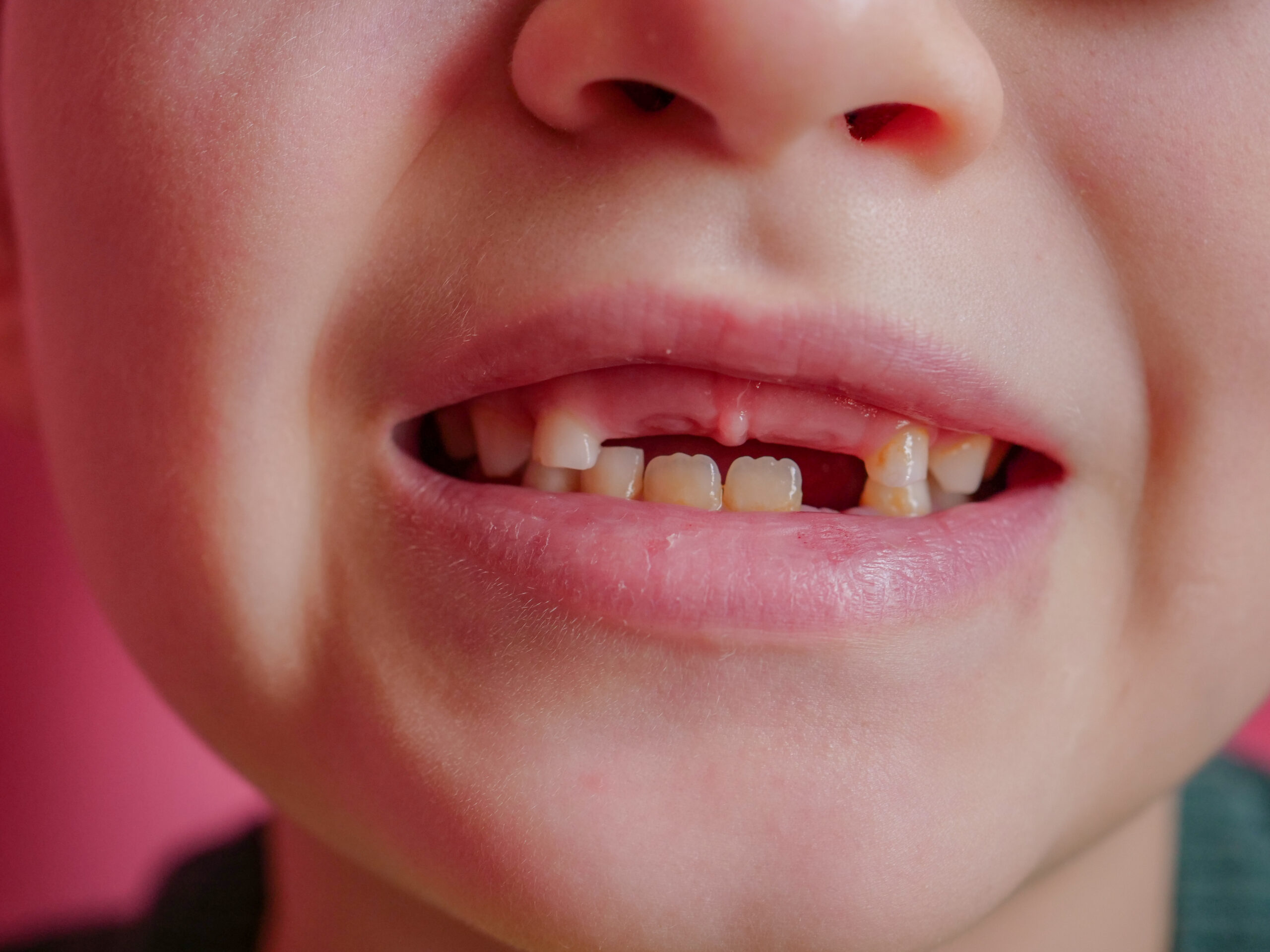 An example of orange teeth in children.