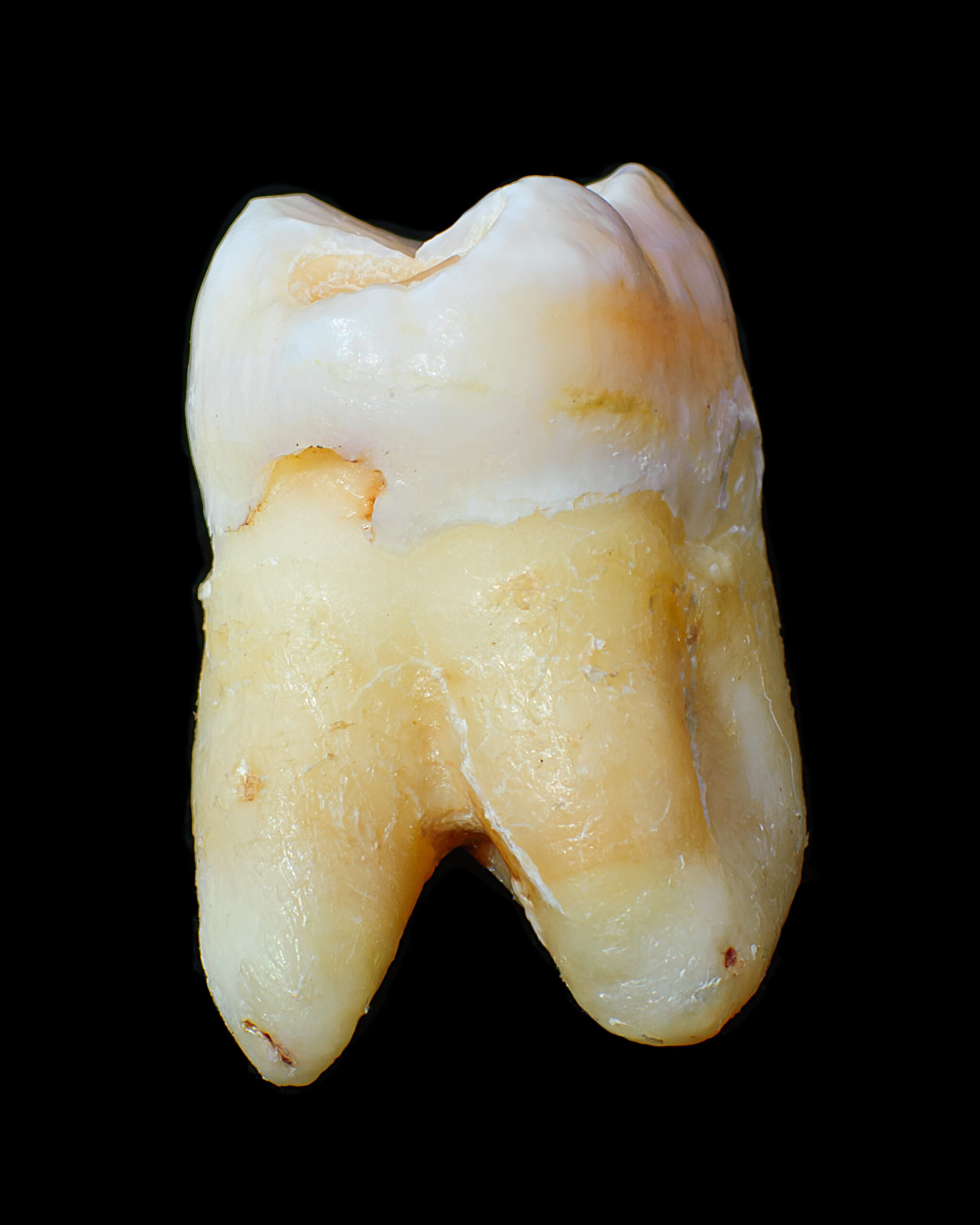 An example of a stained tooth.