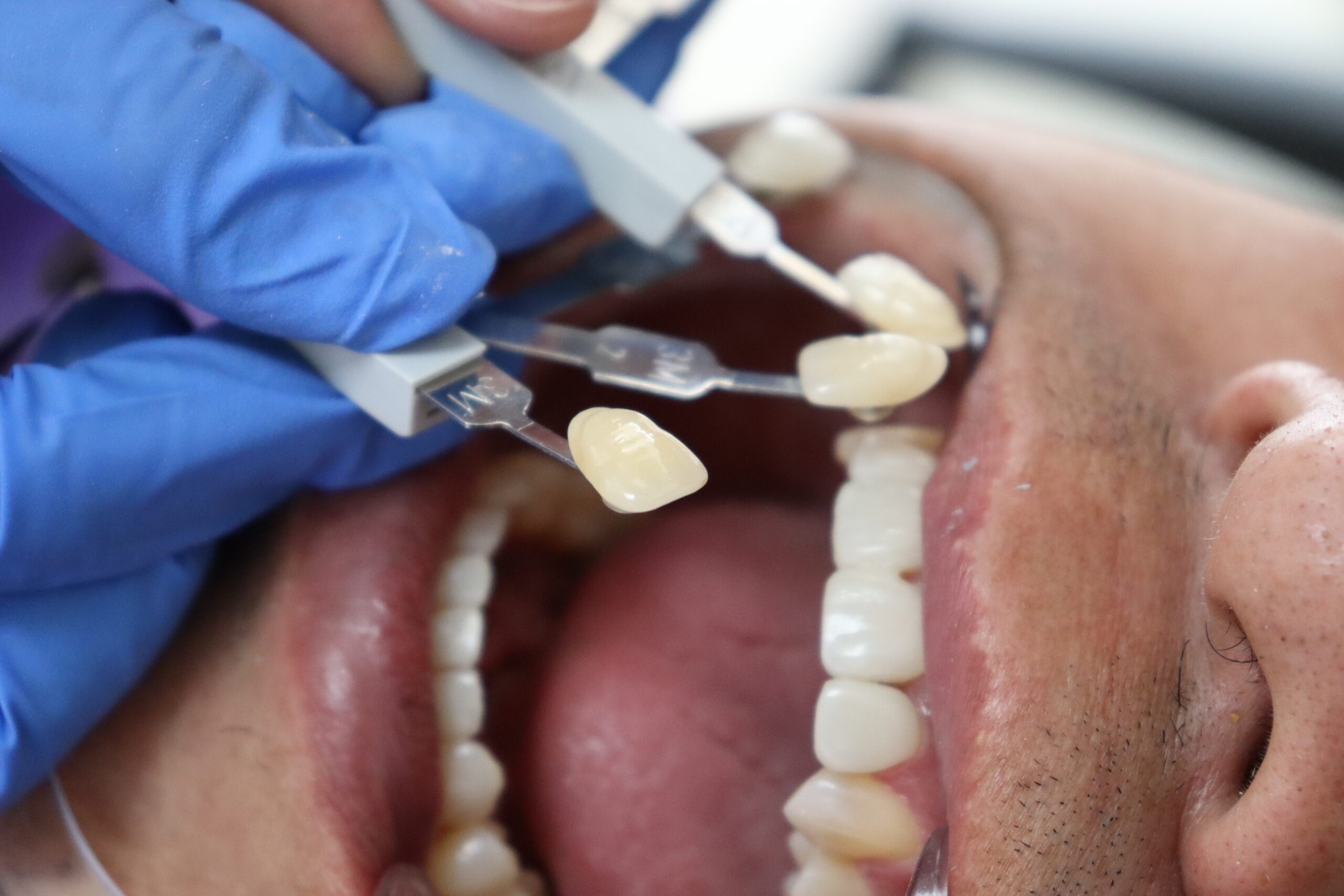 A dentist fixing a woman's problem with veneers.